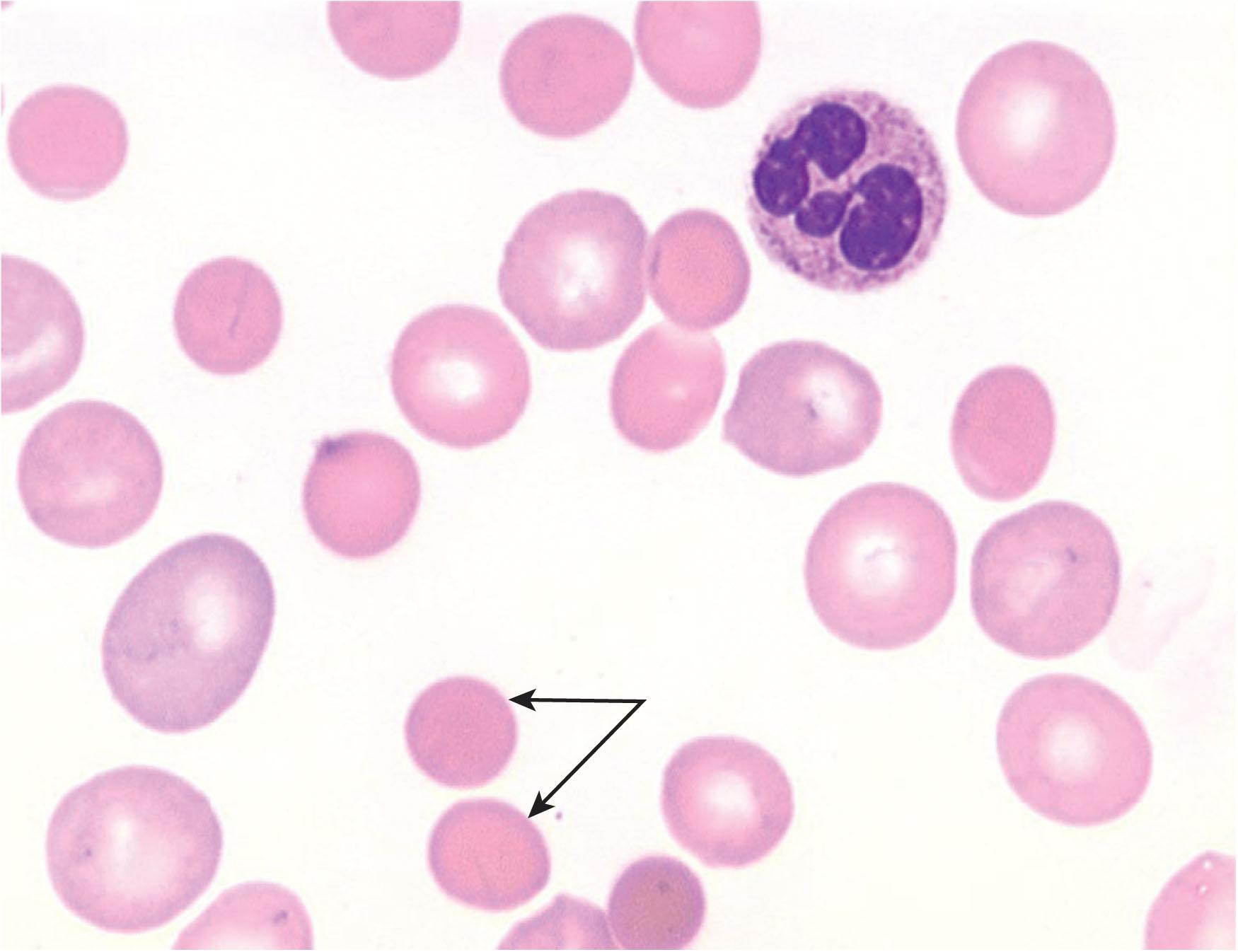 Figure 47.2, BLOOD SMEAR SHOWING NUMEROUS SPHERO-CYTES (ARROWS).