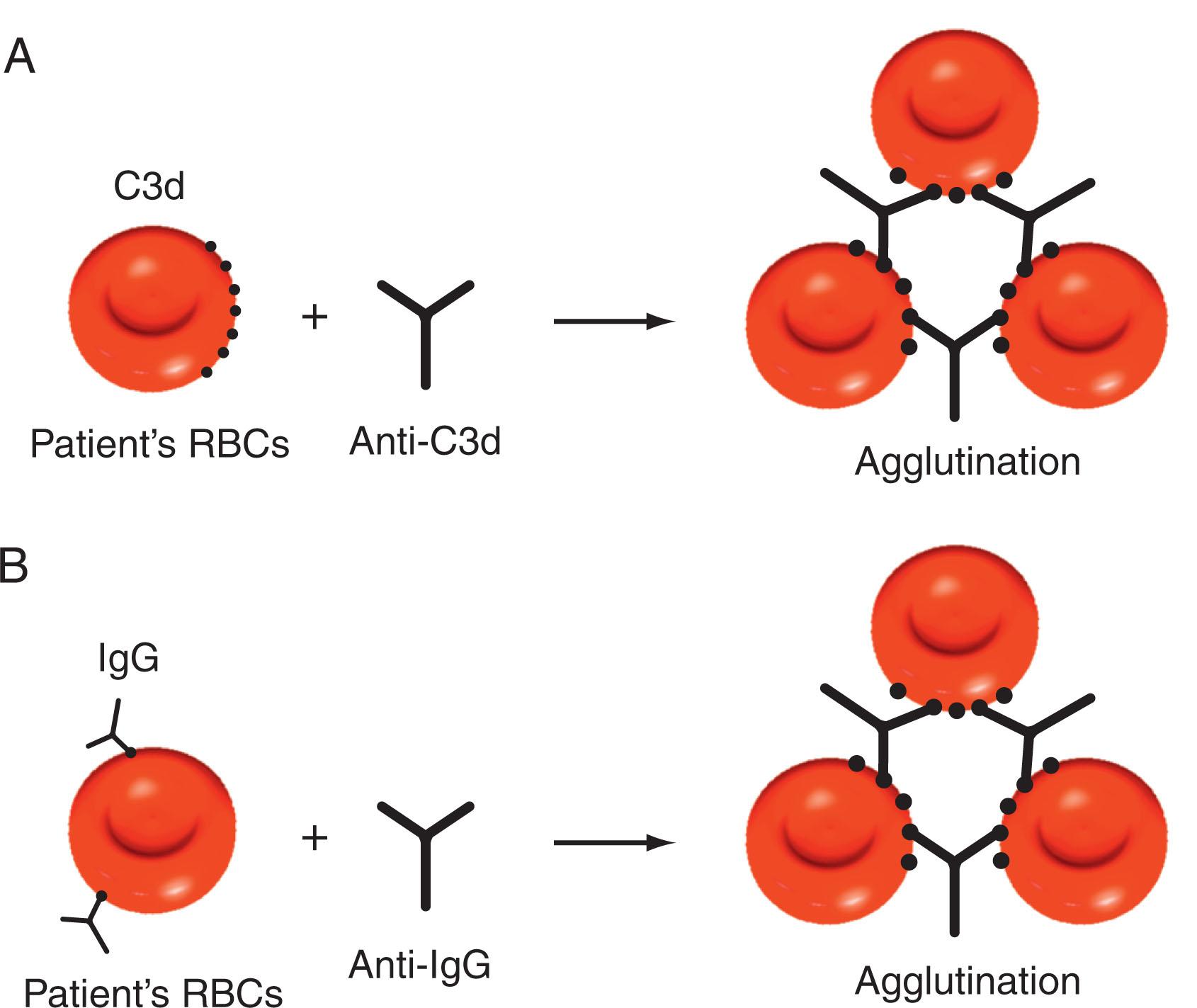 Figure 47.4, DIRECT ANTIGLOBULIN TEST FOR DETECTION OF (A) ERYTHROCYTE-BOUND C3d OR (B) IgG.