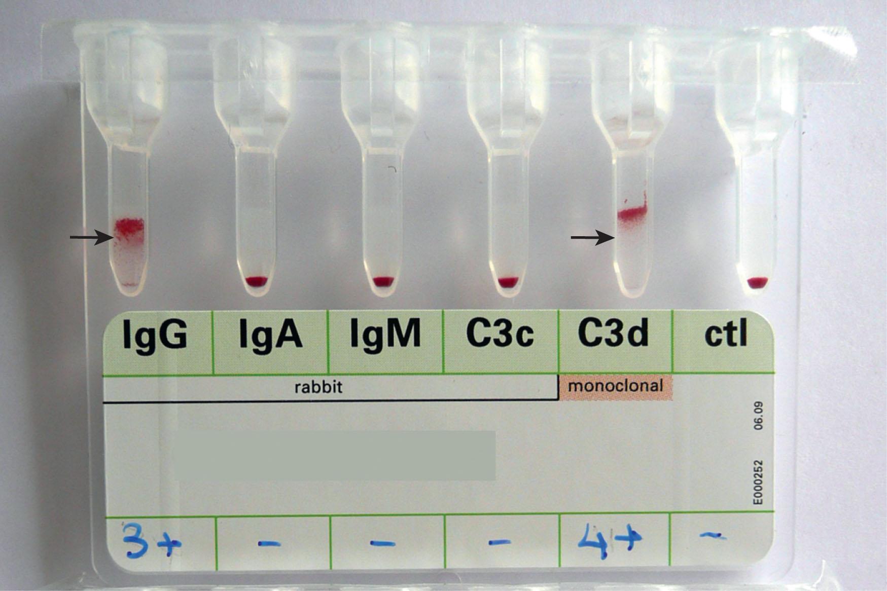 Figure 47.5, RESULT OF A DIRECT ANTIGLOBULIN TEST PERFOMED ON GEL COLUMNS, WITH A POSITIVE RESULT SHOWN WITH AN ANTI-IgG AND ANTI-C3d.