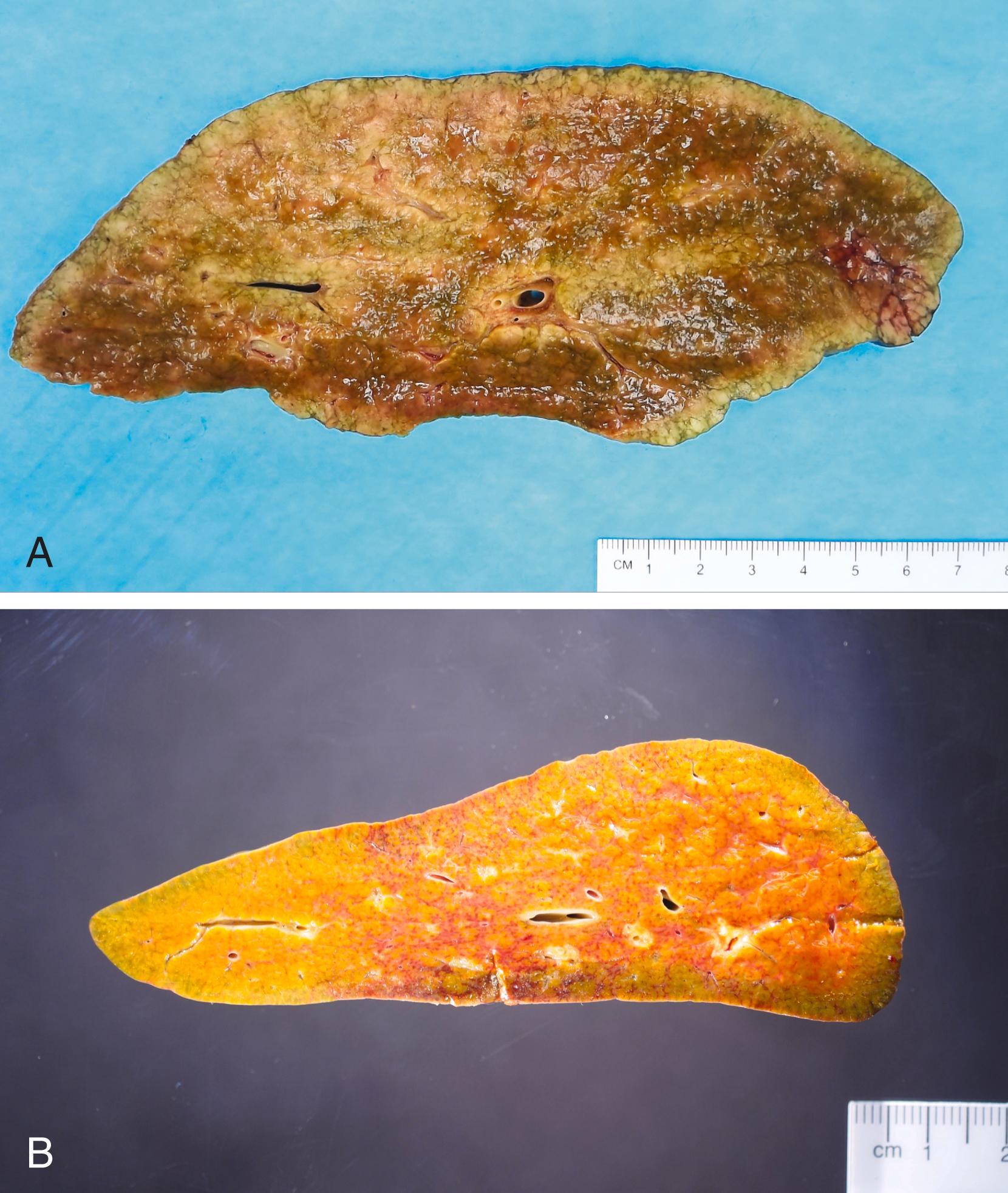 FIGURE 48.1, The liver in autoimmune hepatitis shows no specific gross features.