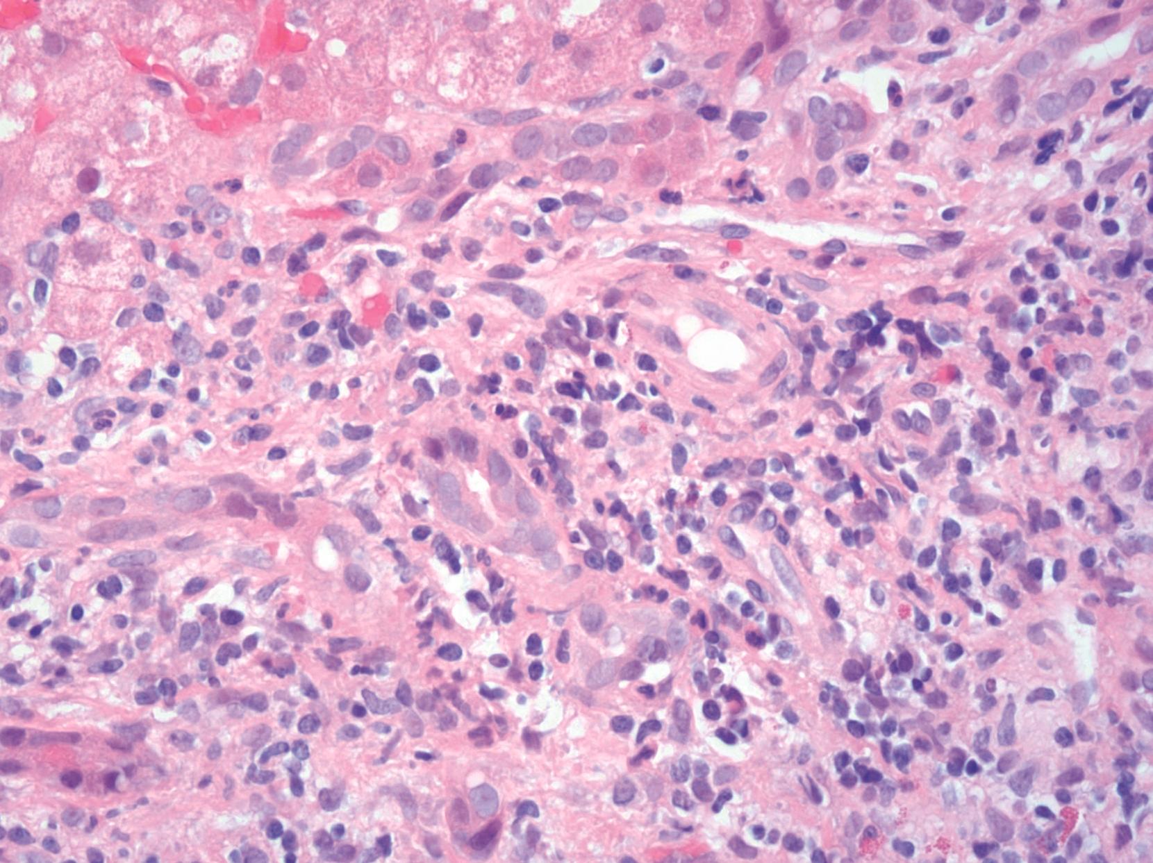 FIGURE 48.2, Native common bile duct branches may be infiltrated by occasional lymphocytes in otherwise typical autoimmune hepatitis. If present at all, bile duct injury is typically mild. Duct loss and florid duct lesions are not typical.