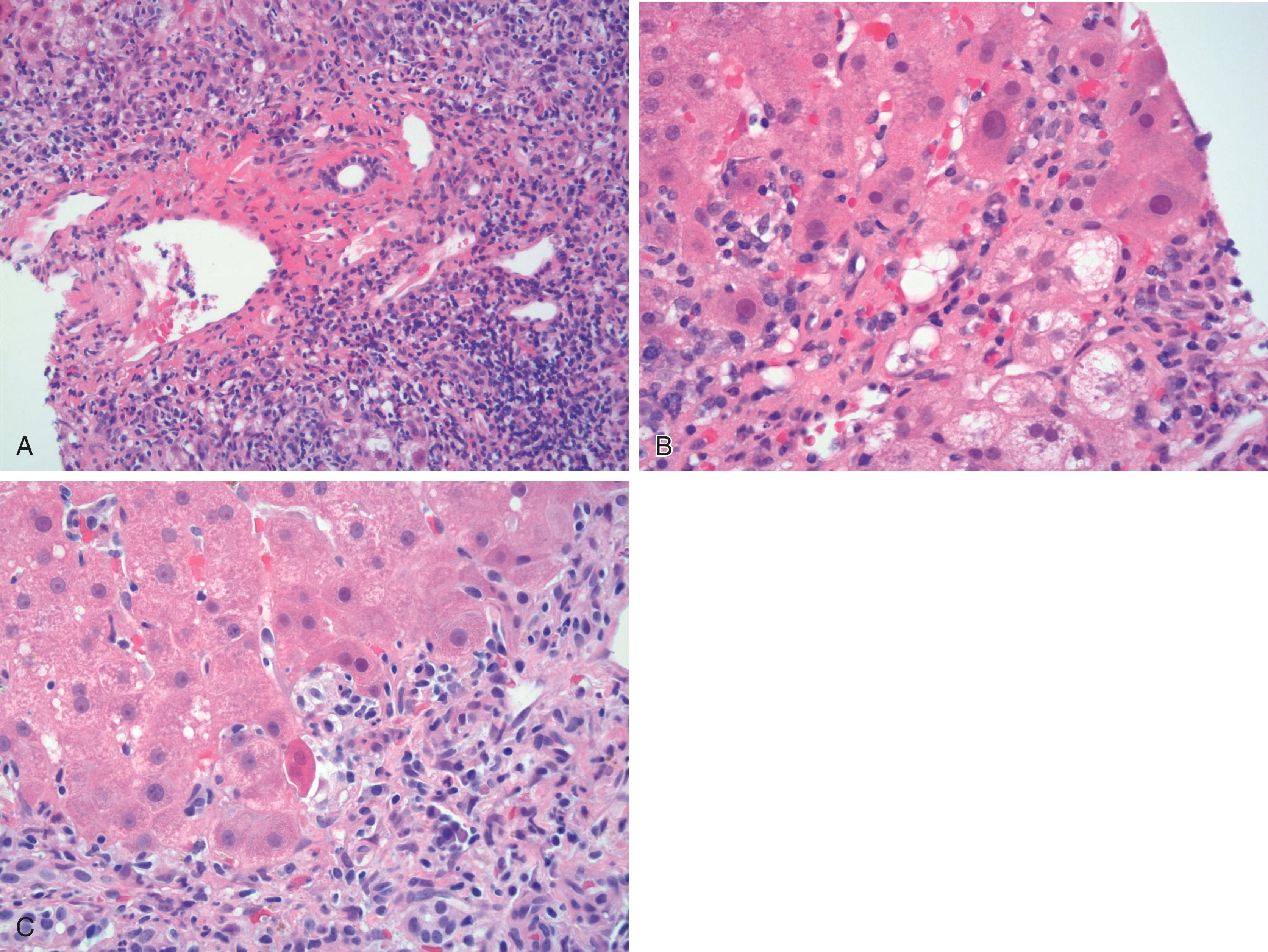 FIGURE 48.4, Autoimmune hepatitis with severe interface hepatitis characterized by diffuse, circumferential activity and associated hepatocellular injury (A). Injured hepatocytes in foci of interface hepatitis show cellular swelling and may exhibit ballooning degeneration (B). Acidophil bodies are frequently seen in foci with interface activity (C).