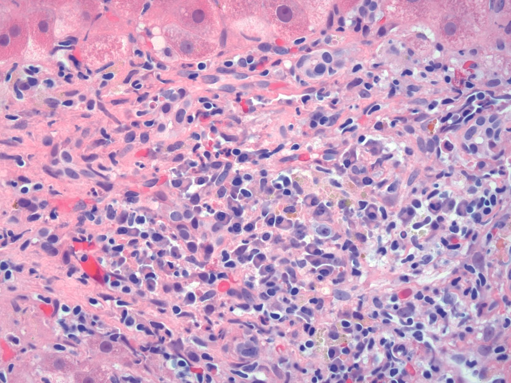 FIGURE 48.5, The presence of numerous plasma cells, including plasma cell clusters, is characteristic of autoimmune hepatitis.