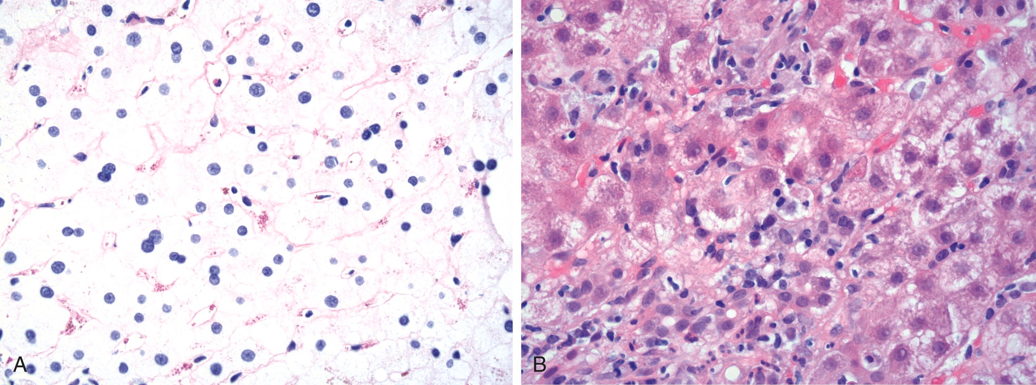 FIGURE 48.6, The presence of hyaline droplets within Kupffer cells is believed to be highly specific for autoimmune hepatitis. These hyaline droplets may be visible on hematoxylin and eosin (H&E)-stained tissue sections, but can be highlighted with a periodic acid-Schiff special stain with diastase digestion (A). Emperipolesis (intact lymphocytes and plasma cells within the cytoplasm of hepatocytes) is identified in most cases of autoimmune hepatitis, though it can be seen in other settings as well (B).