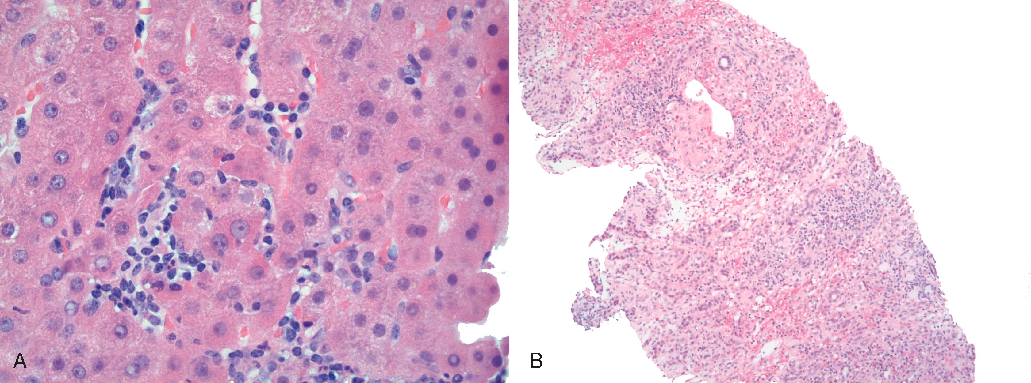 FIGURE 48.7, Lobular necroinflammatory activity is present in most cases of autoimmune hepatitis.