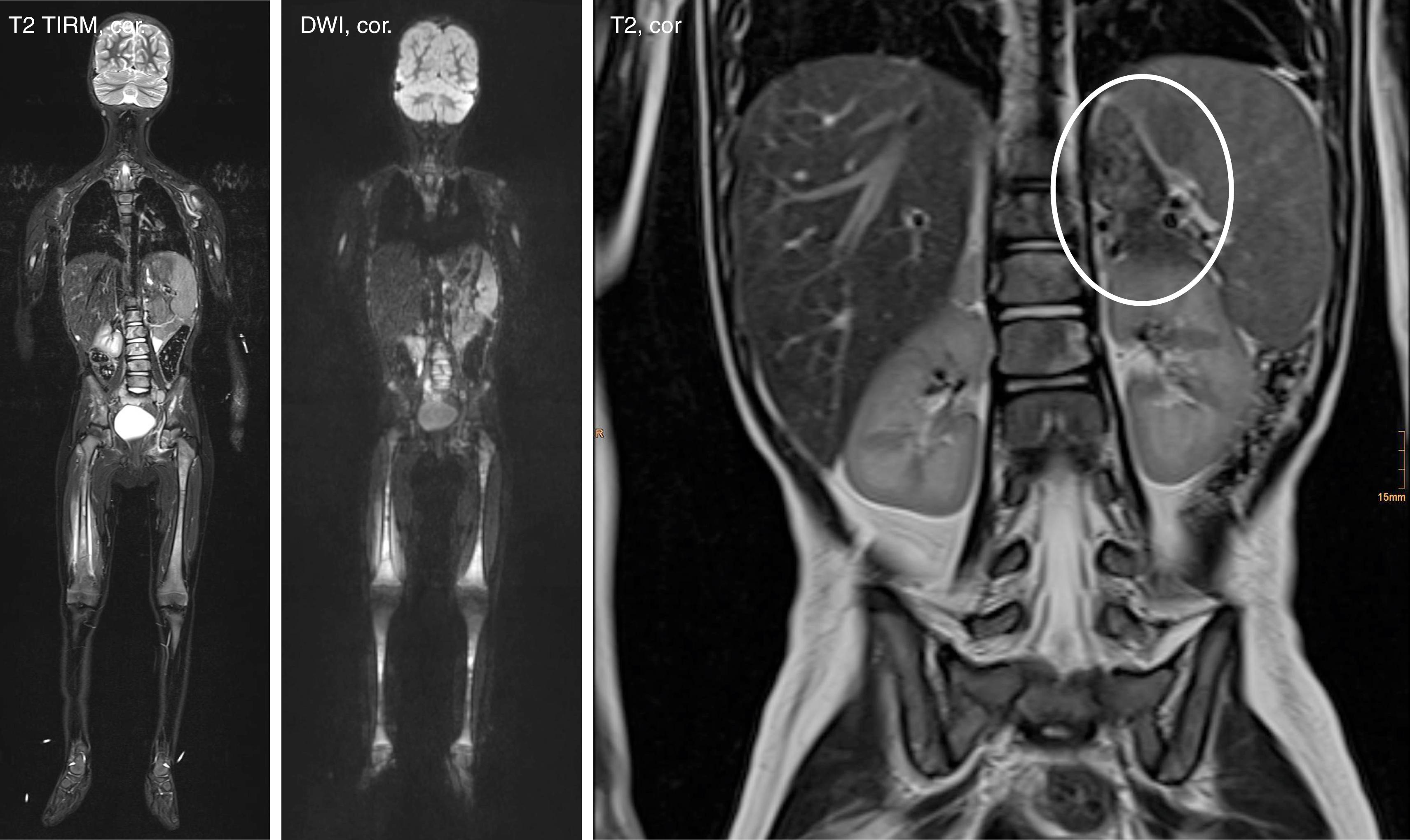 Fig. 40.2, Neuroblastoma with bone marrow infiltration mimicking chronic nonbacterial osteomyelitis (CNO)/chronic recurrent multifocal osteomyelitis (CRMO) in a 2-year-old girl. Whole-body magnetic resonance imaging (MRI) imaging was performed for chronic bone pain and delivered results suggestive of CNO/CRMO. Turbo Inversion Recovery Measurement (TIRM) sequences ( left ) and diffusion-weighted imaging (DWI) ( middle ) show signal alterations over long bones of the lower extremities. Bone biopsy shows bone marrow infiltration of neuroblastoma cells. Local MRI (T2) of adrenal glands shows the primary tumor ( right ).