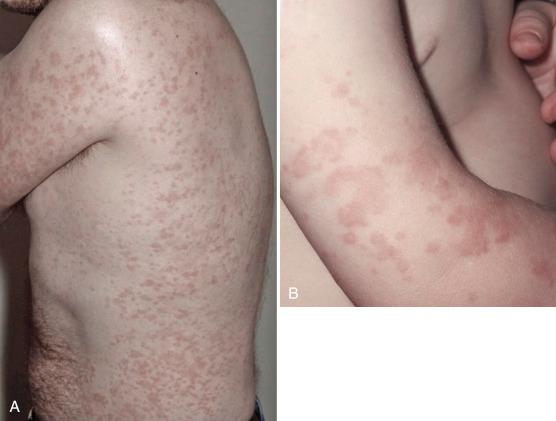 FIGURE 8-2, CAPS rash.