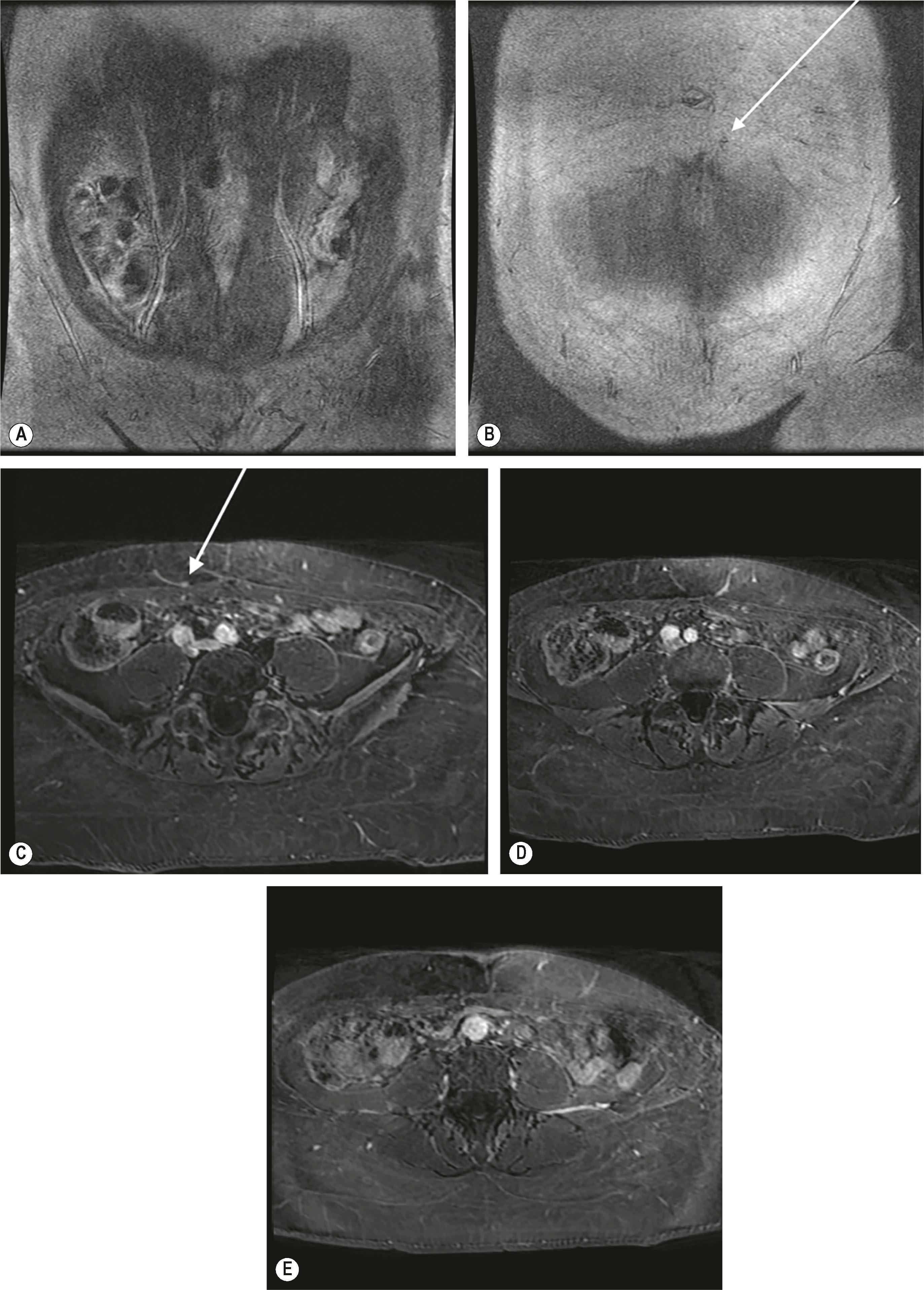 Figure 30.9, Magnetic resonance angiography can provide images that detail the anatomy and muscular course. The branching pattern of the deep inferior epigastric artery (DIEA) can be rapidly assessed in the coronal plane (A) , demonstrating a type II anatomy on the right and type I anatomy on the left. Similarly, the location of a large perforator entering the subcutaneous tissue on the left side is demonstrated (B) . A large right-sided perforator is seen on the axial image (C) , indicated by the arrow, measuring 2.6 mm in diameter at its subcutaneous origin located 26 mm lateral and 45 mm below the umbilicus, with an accompanying 1.9-mm vein. Using other cuts of the same series (not shown), its entire course can be identified; although it exits the fascia quite medially, it is actually arising from the lateral branch of the type II DIEA. There is no subfascial segment, and the intramuscular segment is 3.6 cm, traveling laterally, posteriorly and inferiorly. Within the subcutaneous tissue, it arborizes both medially and laterally in the fat, making it an ideal perforator to supply the hemi-abdomen in this patient requiring a bilateral reconstruction. A similar-sized paraumbilical perforator is identified on the left side (D) , arising from the type I DIEA, measuring 2.4 mm in diameter at its origin, which is 15 mm lateral and 30 mm inferior to the umbilicus with an accompanying 2.4 mm vein. It arborizes laterally in the fat, has no subfascial segment, and a long intramuscular segment at 5.0 cm coursing posteriorly and interiorly. This is the same perforator as that shown on image (B). Scrolling through images allows one to determine the intramuscular course. A representative course can sometimes be captured on one image such as in (E) that demonstrates a 2.7-mm left lateral perforator with accompanying 1.5-mm vein, that is located 51 mm lateral and 13 mm inferior to the umbilicus. It arborizes laterally in the fat, has no subfascial segment, but a winding intramuscular course, traversing the muscle by first coursing medially, then posteriorly and inferiorly for a 5-cm course before becoming submuscular. Because of this winding course and mainly lateral arborization, this is not an ideal perforator for either dissection or flap perfusion if other large perforators with better subcutaneous arborization and a less complicated intramuscular course are identified, such as the perforators on images (C) and (D).