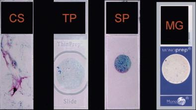 Figure 35-3, The four types of gynecologic preparation. From left to right: the conventional smear, ThinPrep, SurePath, and MonoPrep specimens.