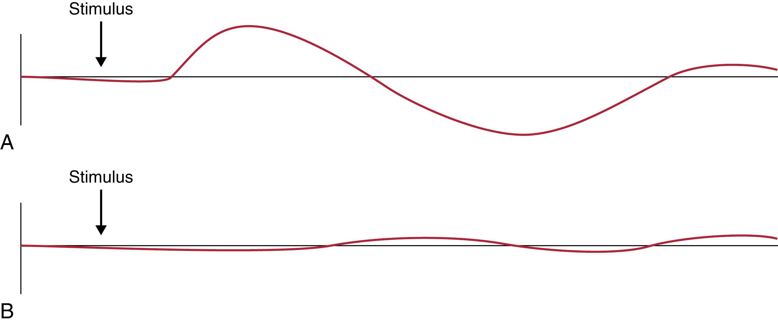 Fig. 5.5, Sympathetic skin response. (A) After a stimulus (a deep breath or an electric shock), a normal sympathetic skin response is shown, with negative and positive deflection noted. The onset latency and magnitude of response can be quantified. (B) A patient with neuropathy has a much smaller magnitude of response and longer onset latency.