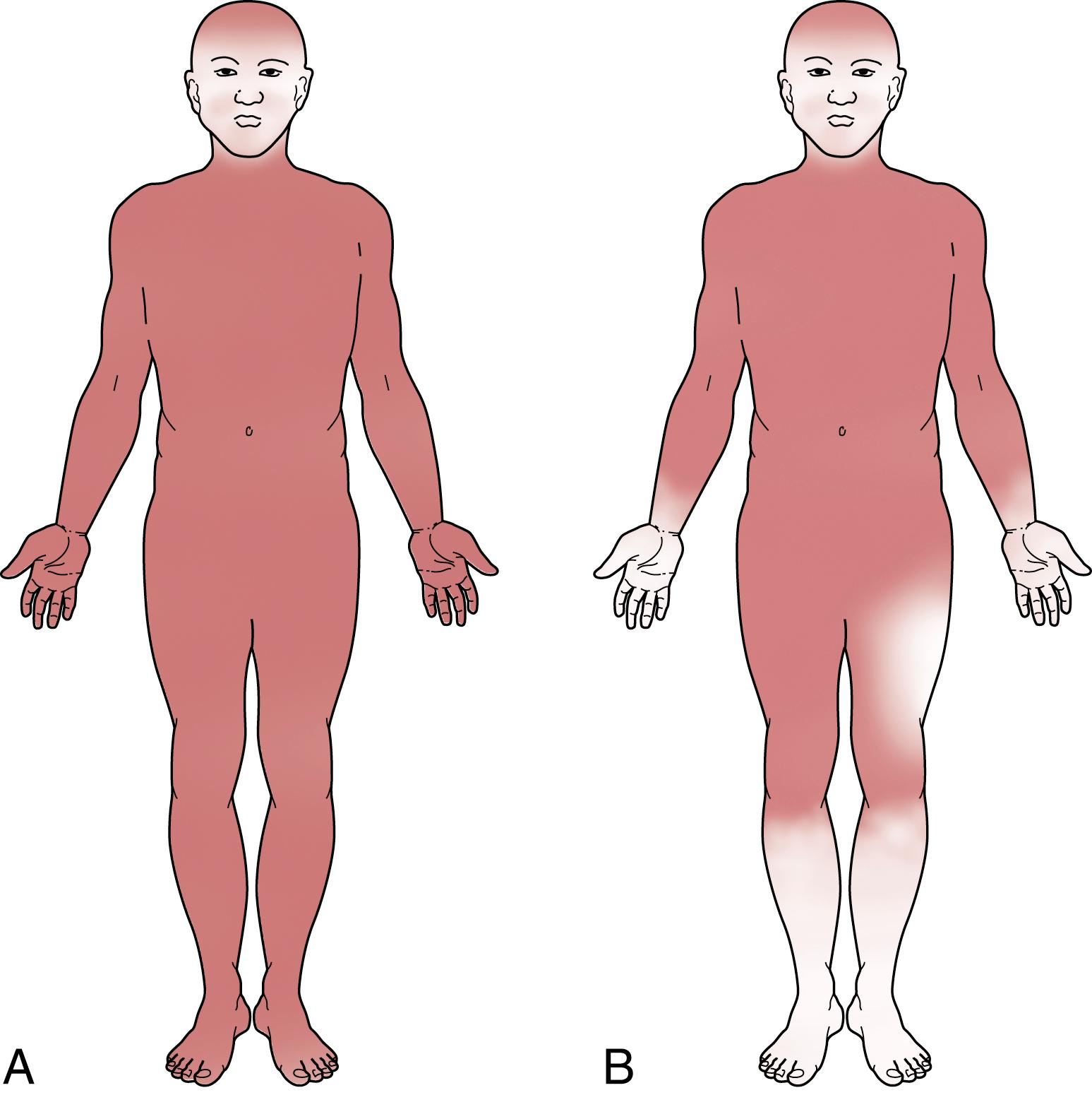 Fig. 5.6, Thermoregulatory sweat testing. Two patients are shown after thermoregulatory sweat testing. The dark areas correspond to regions where sweating has occurred. (A) Normal response. (B) Loss of sweating in a stocking-glove distribution (length-dependent neuropathy, in this case, secondary to diabetes), with additional loss in the left lateral cutaneous nerve distribution.