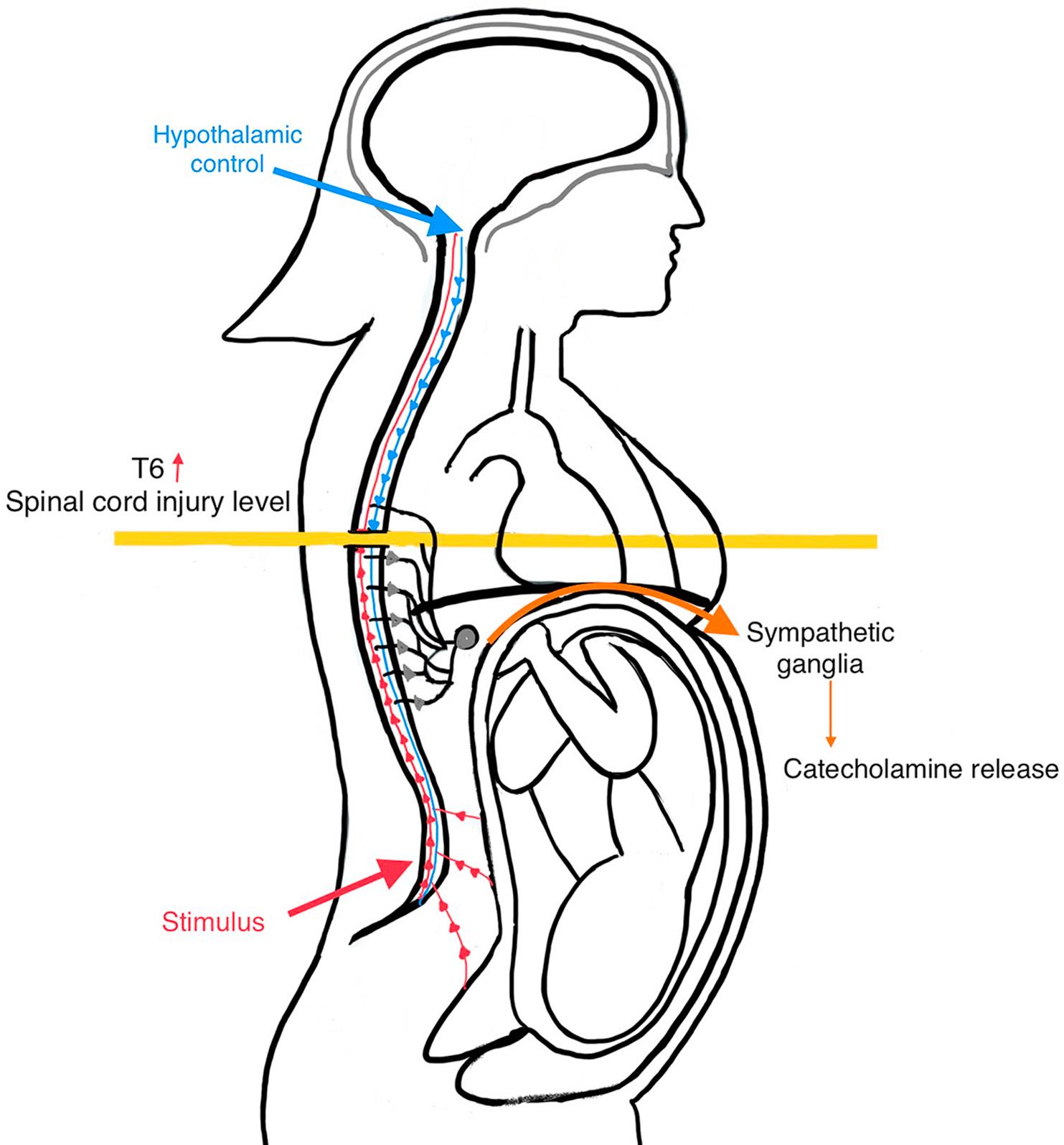 Fig. 27.1, Spinal cord injury prevents descending regulation of efferent sympathetic spinal neurons. Therefore, noxious stimuli result in a reflexic hypersympathetic response.