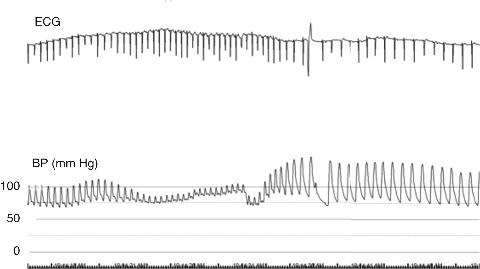 Fig. 67.3, Normal Valsalva response.