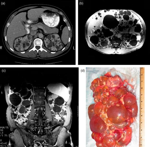 Figure 80.1, Radiographic and gross appearance of ADPKD. a : Contrast enhanced, axial CT image through the abdomen demonstrating moderate polycystic kidney disease, with numerous bilateral renal cysts, preservation of renal parenchyma, and absence of hepatic cysts. b,c : Axial and coronal, gadolinium-enhanced, T1-weighted MR images demonstrating more advanced polycystic kidney and liver disease with marked enlargement of both organs. In both the CT and MR images, cysts appear as hypodense areas within the organ parenchyma. d : Nephrectomy specimen from a patient with ADPKD and end-stage renal disease. Cysts permeate the mass of the kidney and the noncystic regions are fibrotic and scarred.