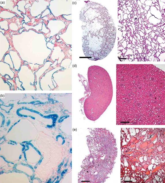 Figure 80.3, Mouse models of polycystic kidney disease. a : Conditional mouse model of polycystic kidney disease due to homozygous inactivation of Pkd1 in some nephron segments. Cells in the kidney that have undergone inactivation of Pkd1 are marked by the β-galactosidase expression (blue) from a Cre-recombinase reporter expressing lacZ . Tubule segments (*) and glomeruli ( arrowheads ) in which Pkd1 is not inactivated appear normal but are confined to septa between expanding cysts lined by cells stained blue indicating Pkd1 has been inactivated. b : Chimeric mice produced from Pkd1 − / − ES cells aggregated with wild type morulae marked by constitutive lacZ expression show mosaic cyst formation. Cyst lining are comprised of cuboidal wild type cells ( blue staining ) and flat Pkd1 − / − cells that do not express lacZ and are therefore unstained (indicated by arrows). (Images courtesy of Stefan Somlo and Saori Nishio). c : Early inactivation of Pkd1 results in rapidly progressive cyst formation; cystic kidneys postnatal day 19 following inactivation of Pkd1 on postnatal day 2. d,e : Adult inactivation of Pkd1 results in slowly progressive polycystic kidney disease. Kidneys at 3 months ( d ) following inactivation at 1.5 months show no overt cysts; kidneys at 6 months ( e ) following inactivation at 1.5 months show progressive cyst formation. d–e : Scale bars, 2 mm (left panels); 100 μm (right panel).