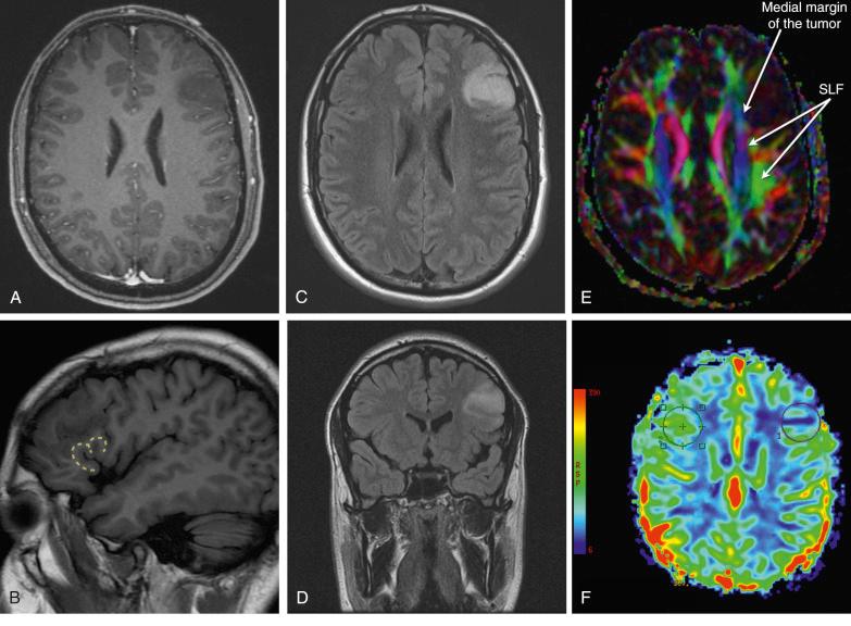 Figure 1.1, (A–F) Preoperative imaging for a left frontal lesion consistent with a low-grade glioma. (A) Axial T1-weighted MRI with contrast showing the characteristic non-enhancement of low-grade gliomas. (B) Sagittal T1-weighted MRI without contrast. An “M-shaped” gyrus has been highlighted with a yellow dotted line. It is an MRI landmark to locate the pars orbitalis, triangularis and opercularis of the inferior frontal gyrus. This region is related to Broca's area. (C) Axial T2-weighted FLAIR showing hyperintense signal at the frontal lobe, anterior to the insula. (D) Coronal T2-weighted FLAIR showing a hyperintense signal at the medial and inferior frontal gyrus. (E) Axial DTI showing displacement of white matter tracts medially and the anatomic relation between the tumor and the superior longitudinal fascicle (SLF). (F) PET image showing decreased uptake at the left frontal region, correlating with the lesion site.