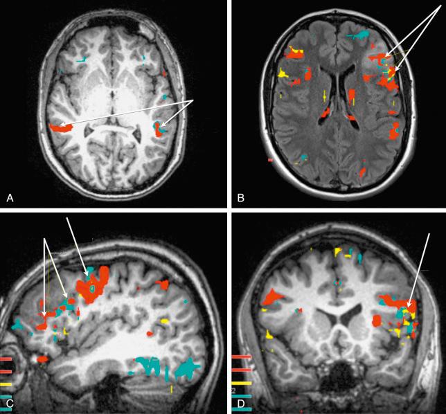 Figure 1.3, Preoperative fMRI. (A) Axial T1-weighted MRI showing bilateral codominant activation of Wernicke's areas. (B) Axial T2-weighted FLAIR showed Broca's area involved within the lesion and left dominance was evident. (C) Sagittal T1-weighted MRI showing the relation in between the lesion and Broca's area (double arrow) and dorso-lateral prefrontal area (single arrow). (D) Coronal T1-weighted MRI. The left Broca's area is displaced inferiorly probably due to redistribution of the language function, suggesting evidence of plasticity. The invasion of eloquent areas favored the use of an awake craniotomy with speech mapping.