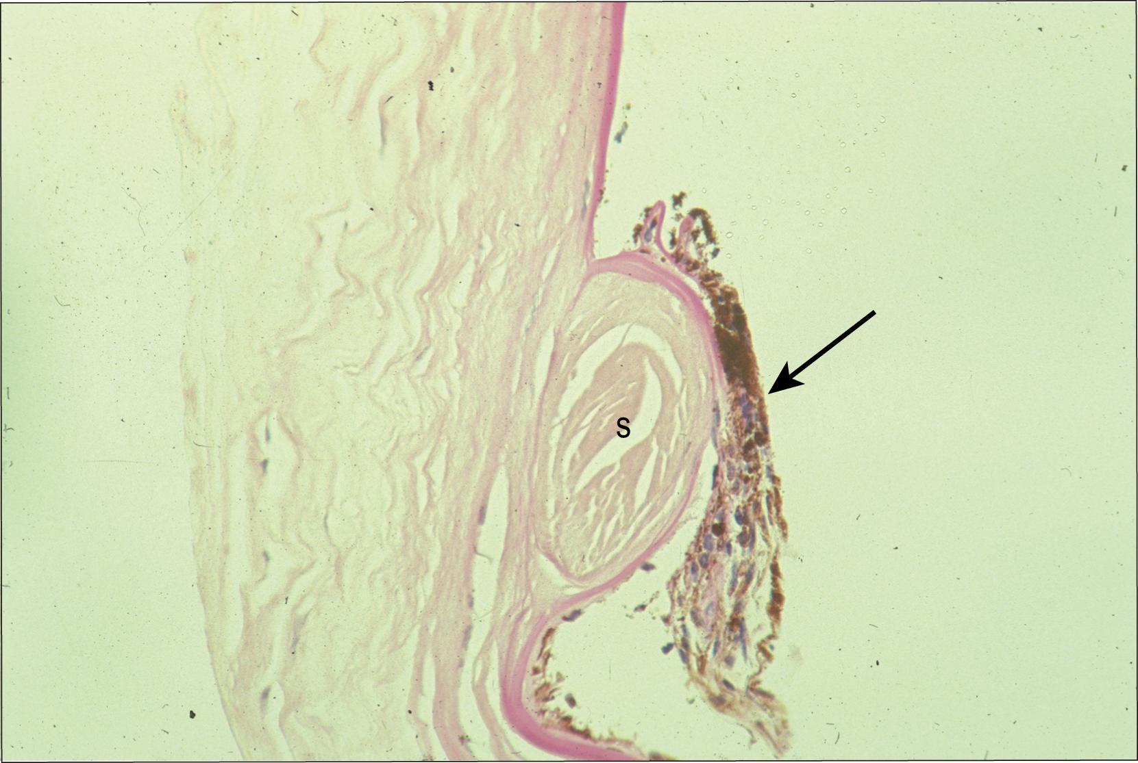 Fig. 56.2, Histopathology of posterior embryotoxon with adherent iris tissue.