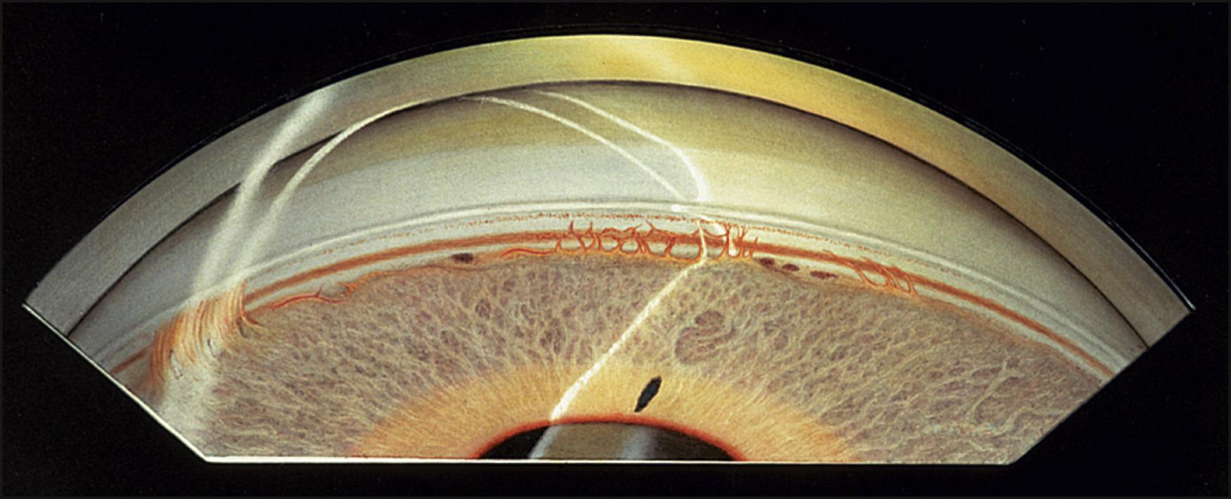 Fig. 56.3, Iris processes in the iridocorneal angle of a patient with Axenfeld-Rieger syndrome. Multiple connections are noted between the iris and the posterior embryotoxon. There is a broader adhesion to the posterior embryotoxon on the left portion of the illustration.