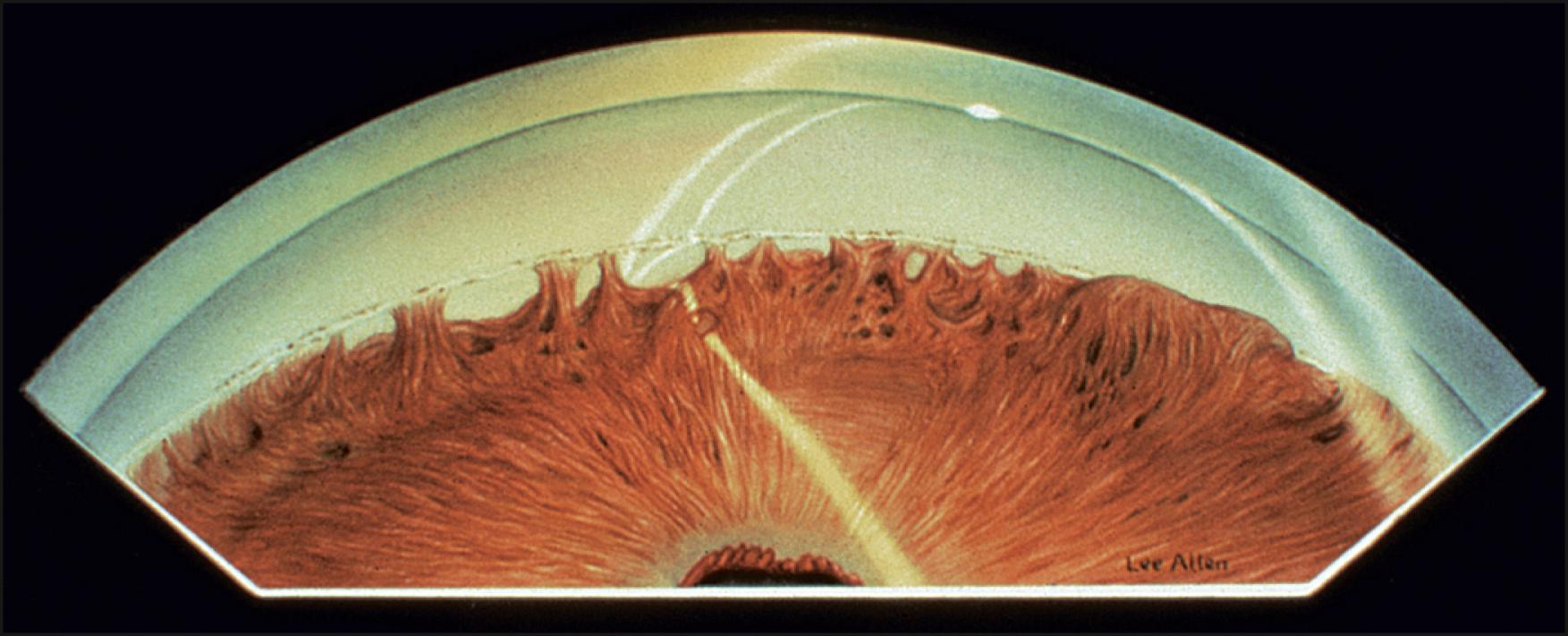 Fig. 56.4, The iris processes in this patient with Axenfeld-Rieger syndrome are much denser and more confluent than those seen in Fig. 56.3 . They cover much of the trabecular meshwork.
