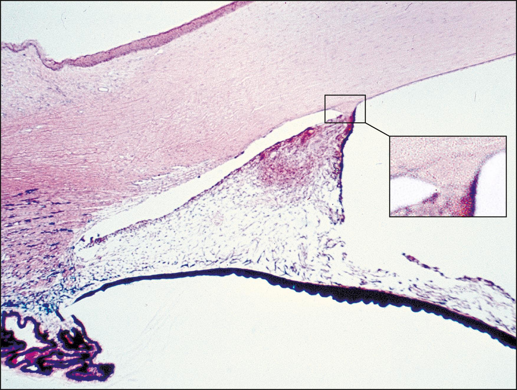 Fig. 56.5, Histopathology of the iridocorneal angle in Axenfeld-Rieger syndrome. There is an area of adhesion between the iris and posterior embryotoxon (inset) . The iris inserts high into the trabecular meshwork.