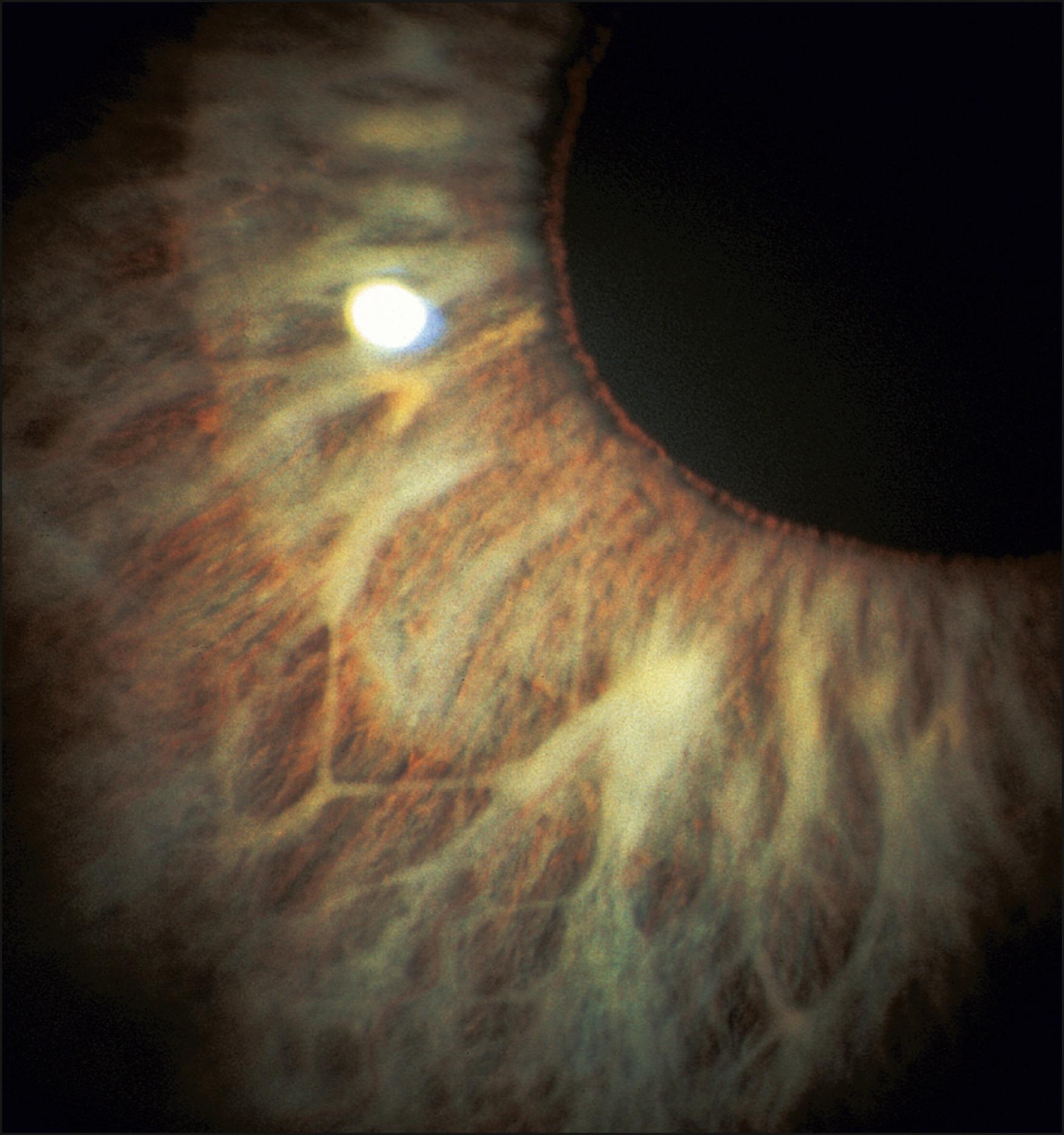 Fig. 56.6, Iris hypoplasia.