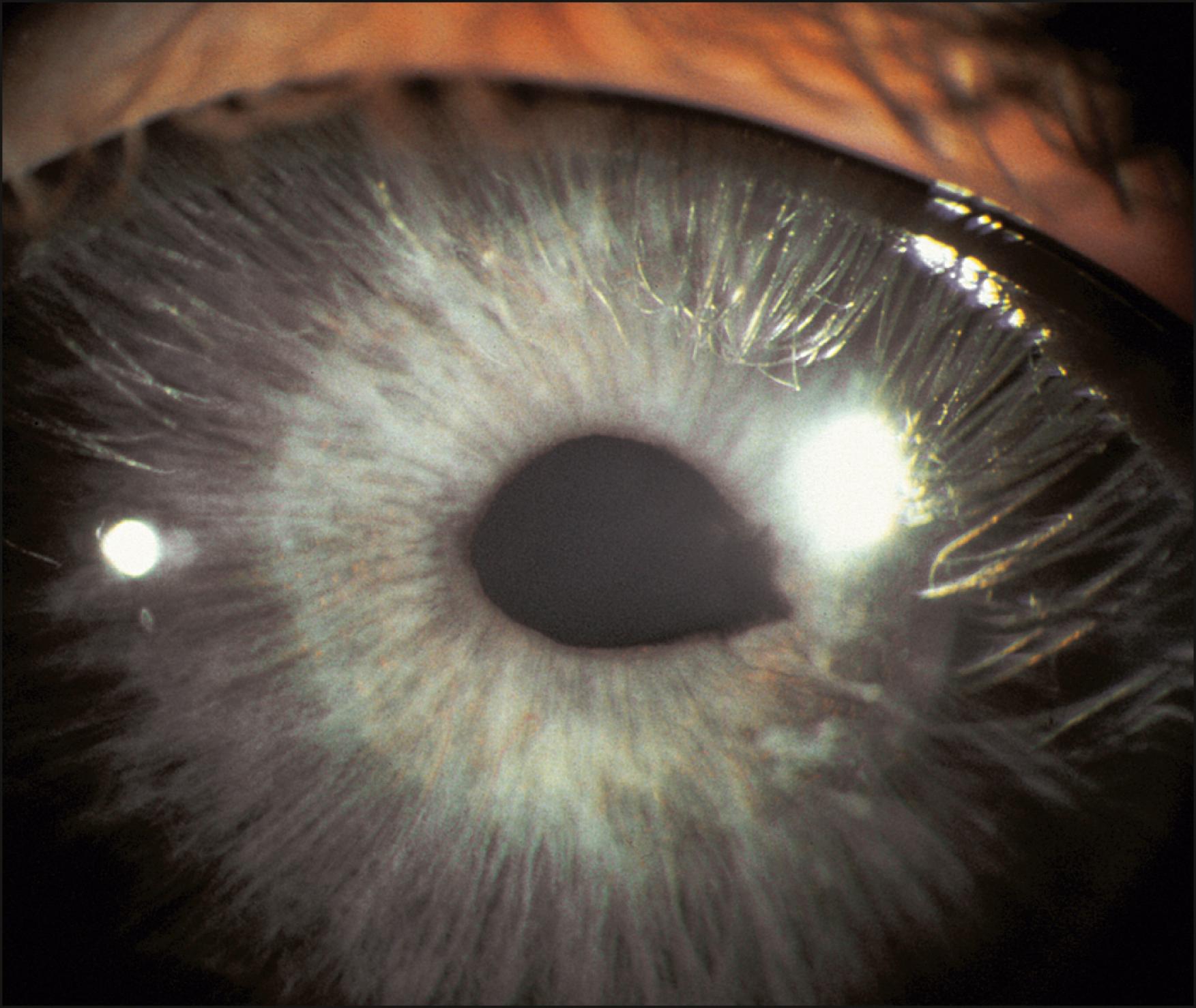 Fig. 56.7, Mild corectopia in a patient with Axenfeld-Rieger syndrome.