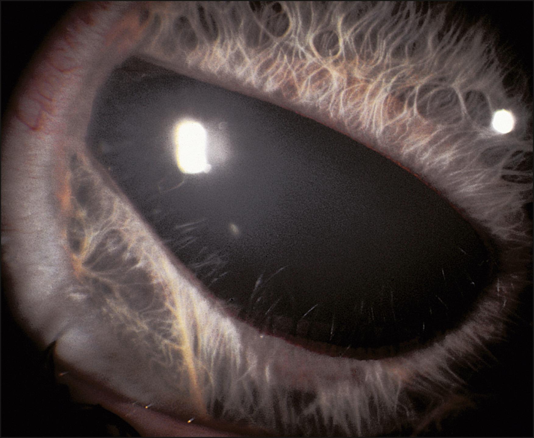 Fig. 56.8, Axenfeld-Rieger syndrome.