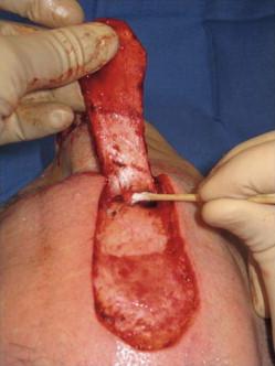 FIGURE 18.12, When the yellow fat deep to the corrugator muscle becomes visible, blunt dissection is used to push the muscle fibers away from the periosteum. The STA runs superficial to the corrugator, so incision through periosteum is not necessary to protect it. A cotton-tipped applicator is used to free the pedicle base from the periosteum.