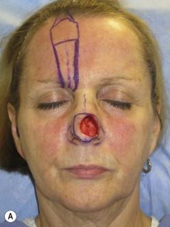 FIGURE 18.4, (A) Loss of dome of left lower lateral cartilage. (B) Tip cartilage graft to restore the natural convexity of the nasal bulb.