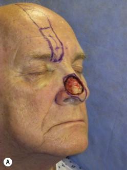FIGURE 18.6, (A) Defect involving the right nasal hemitip. (B) Immediate postoperative appearance after wound was repaired as a hemitip subunit, rather than extending the defect to involve the entire nasal tip subunit. (C) Appearance at 6 months postoperatively. The midline scar is imperceptible, demonstrating that replacement of the entire cosmetic subunit is not always necessary.