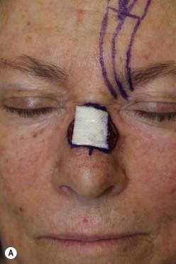 FIGURE 18.7, (A) Nasal dorsum skin expands after tumor resection. The forehead template must account for this expansion and should be slightly undersized. (B) Comparison of template to defect.