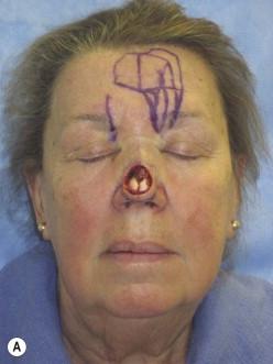 FIGURE 18.8, (A) Patient with a tight forehead and low hairline has a template designed transversely in order to avoid hairs on the flap. (B) Immediate postoperative appearance demonstrating that perfusion via the subdermal plexus is sufficient to nourish the distal end of the flap. Note that the donor site was too tight for primary closure. (C) Appearance at 3 months postoperatively. The small open wound at the forehead donor site has healed acceptably; no revision was performed.