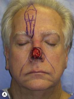 FIGURE 18.9, (A) A template of the nasal defect has been transferred to the forehead donor site inferior to the hairline. The path of the supratrochlear artery (STA) has been mapped with a Doppler device, and the flap pedicle is based around the STA. The pedicle base has a width of 1.2 cm and fans out to meet the templated portion of the flap. Since the defect is located in the midline, either side of the forehead would serve as a suitable donor site. (B) The incision is limited to the templated portion of the flap to minimize bleeding. (C) For this planned two-stage flap, the entire templated portion is elevated superficial to the frontalis muscle. The absence of bleeding at the flap base indicates that the supratrochlear vessels are intact.