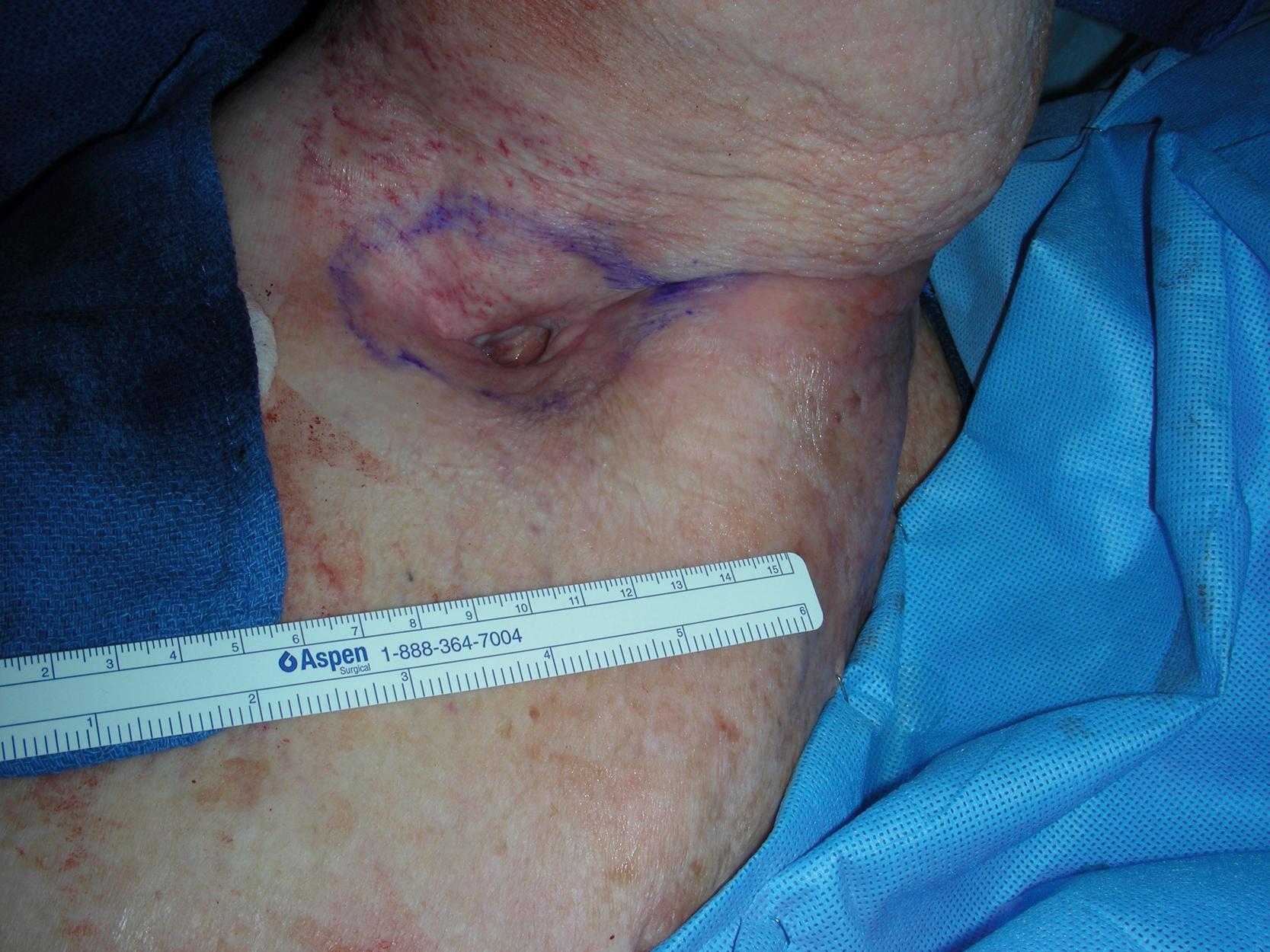 Fig. 15.1, Preoperative view showing a chronic and radiated deep axillary wound with surrounding fibrotic and scarred tissues.