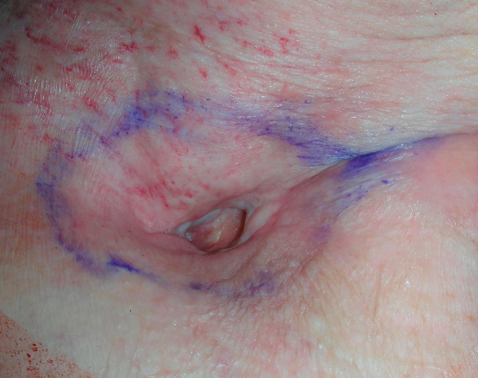 Fig. 15.2, Preoperative close-up view showing this deep axillary wound with surrounding fibrotic and scarred tissues.