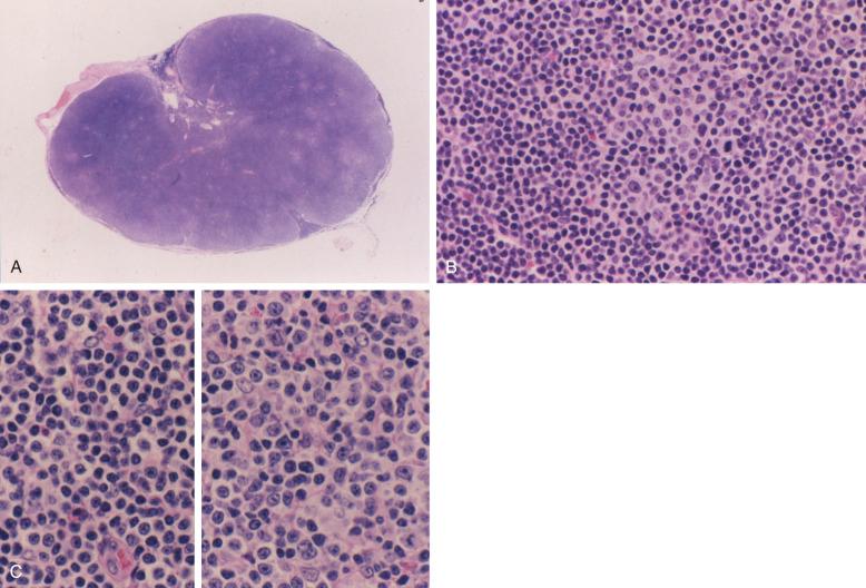 Figure 14-1, A, Low-power photomicrograph of a lymph node shows diffuse effacement with multiple pale proliferation foci, B, High-power photomicrograph of proliferation foci in a lymph node illustrates larger lymphoid cells with more abundant cytoplasm and more dispersed nuclear chromatin. C, This composite illustrates the side-by-side comparison of the small lymphocytes of CLL/SLL (left) with the larger lymphoid cells comprising a proliferation foci (right).