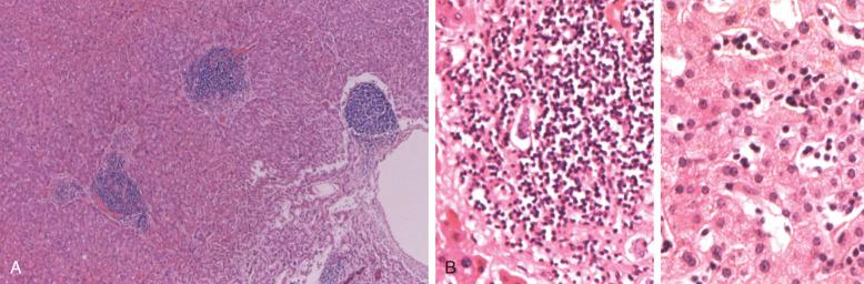 Figure 14-11, A, Low-power photomicrograph of liver from a patient with CLL shows distinctive portal infiltrates. B, Composite of liver sections illustrates both portal and sinusoidal infiltrates in a patient with CLL/SLL.