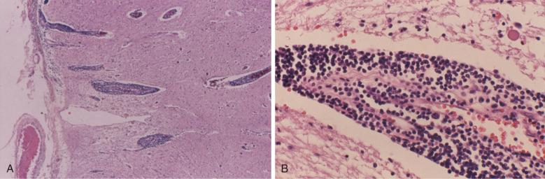 Figure 14-12, A, Low-power photomicrograph of brain from an autopsy on a patient with CLL/SLL shows prominent infiltration of dark lymphoid cells in Virchow-Robin spaces. B, On high power, the lymphoid infiltrate consists of small, round, mature lymphocytes with scanty cytoplasm typical of CLL/SLL.