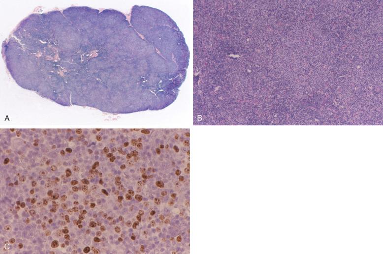 Figure 14-2, A, More prominent and confluent pale proliferation foci are evident on this low-power photomicrograph of a lymph node in a patient with CLL/SLL. B, Higher-power magnification shows confluent pale proliferation foci in a patient with CLL/SLL. C, Ki67 positivity is fairly prominent in the proliferation foci in this CLL/SLL case with prominent confluent proliferation foci (H&E and Ki67 stains by immunoperoxidase).