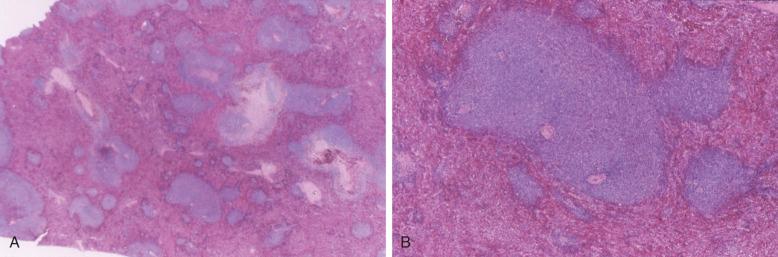 Figure 14-4, Expanded dark-staining white-pulp infiltrates of CLL/SLL are evident at low (A) and intermediate (B) magnification in this spleen.