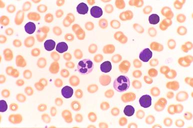 Figure 14-5, A marked mature lymphocytosis characterized by round nuclei with highly condensed chromatin and scant cytoplasm is evident in blood from a patient with CLL (Wright's stain).