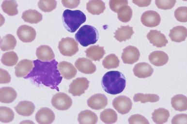 Figure 14-6, Broken CLL cells (so-called smudge cells ) are evident on this peripheral blood smear from a patient with CLL. Smudge cells consist largely of nuclear material (Wright's stain).