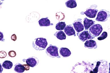 Figure 14-7, Larger lymphoid cells with more dispersed chromatin and distinct nucleolus (so-called prolymphocytes ) are evident on this cytospin in blood from a patient with CLL (Wright's stain).