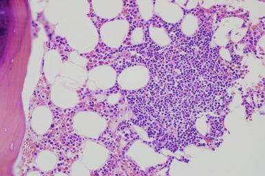 Figure 14-8, Bone marrow core biopsy section from a patient with CLL illustrates a focal, non-paratrabecular infiltrate of leukemia. Note the dark blue color of this infiltrate due to the back-to-back nuclei that typify CLL infiltrates.