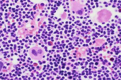 Figure 14-9, Bone marrow biopsy section from a patient with CLL illustrates the diffuse, interstitial infiltration that can occur in some patients. Note abundant preserved megakaryocytes.