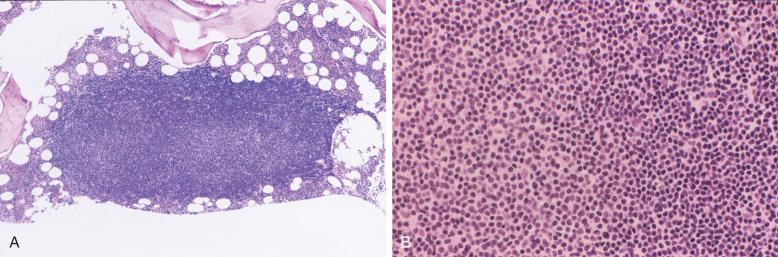 Figure 14-10, A, Low-power photomicrograph of a bone marrow core biopsy from a patient with CLL illustrates a large focal infiltrate with a pale central proliferation foci, an unusual finding in bone marrow specimens. B, High-power photomicrograph shows the larger prolymphocyte-like cells (left) comprising the proliferation foci compared with the small, dark typical CLL cells (right) with scanty cytoplasm and highly condensed chromatin.