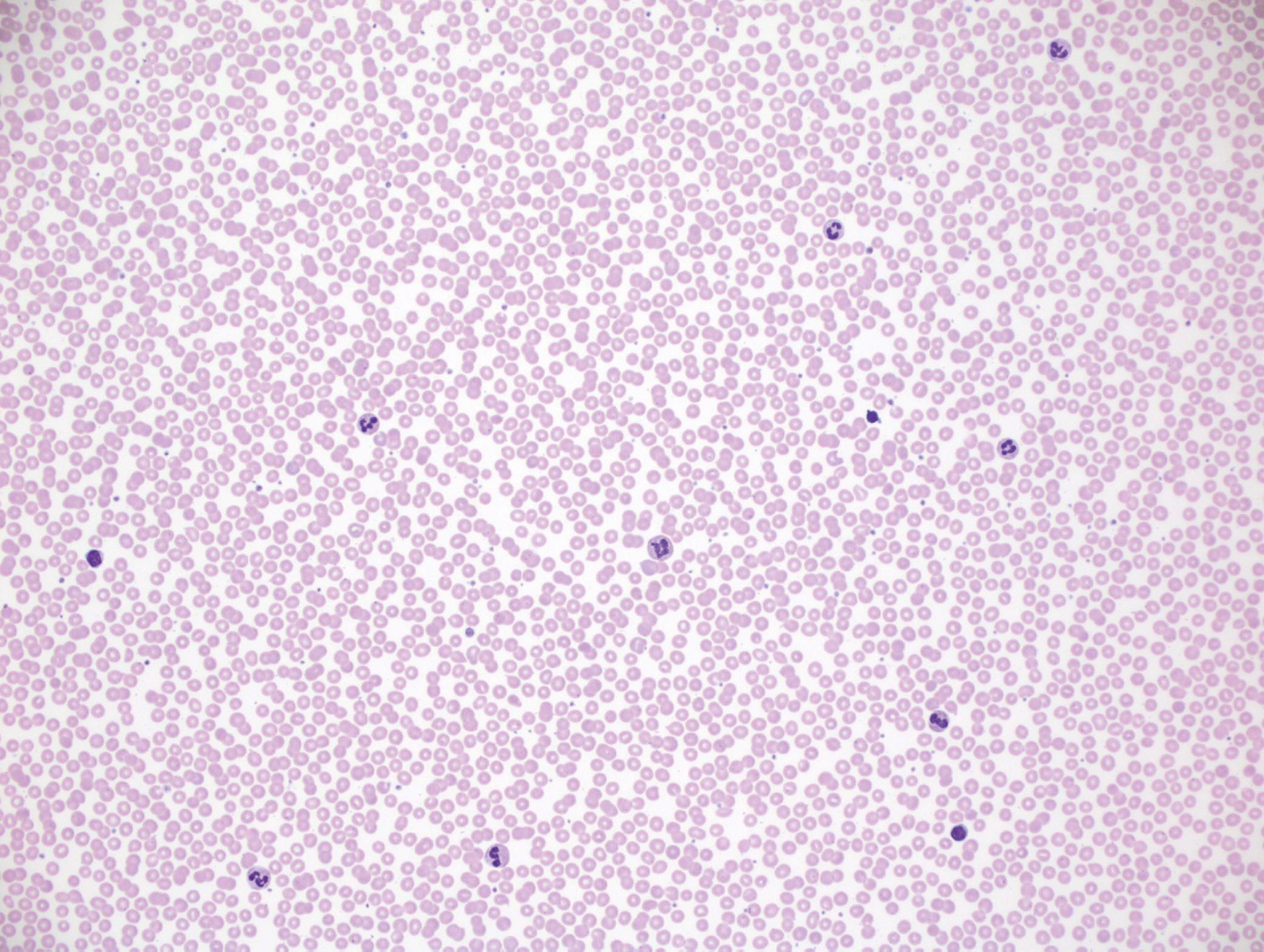 Fig. 10.16, Blood smear from a patient with incidentally identified monoclonal B-cell lymphocytosis found during workup to evaluate for multiple myeloma. As seen in this image, the blood smear is commonly unremarkable in patients with MBL (white blood cell count = 9.8 × 10 9 /L, absolute lymphocyte count = 3.4 × 10 9 /L). Flow cytometry performed on a concurrent bone marrow aspirate showed 2% of leukocytes to be clonal B cells with a chronic lymphocytic leukemia (CLL)-like phenotype. A myeloma fluorescence in situ hybridization panel demonstrated del(13q) in 13% of cells, likely representing the CLL-like clonal population. There was no evidence of a plasma cell dyscrasia.