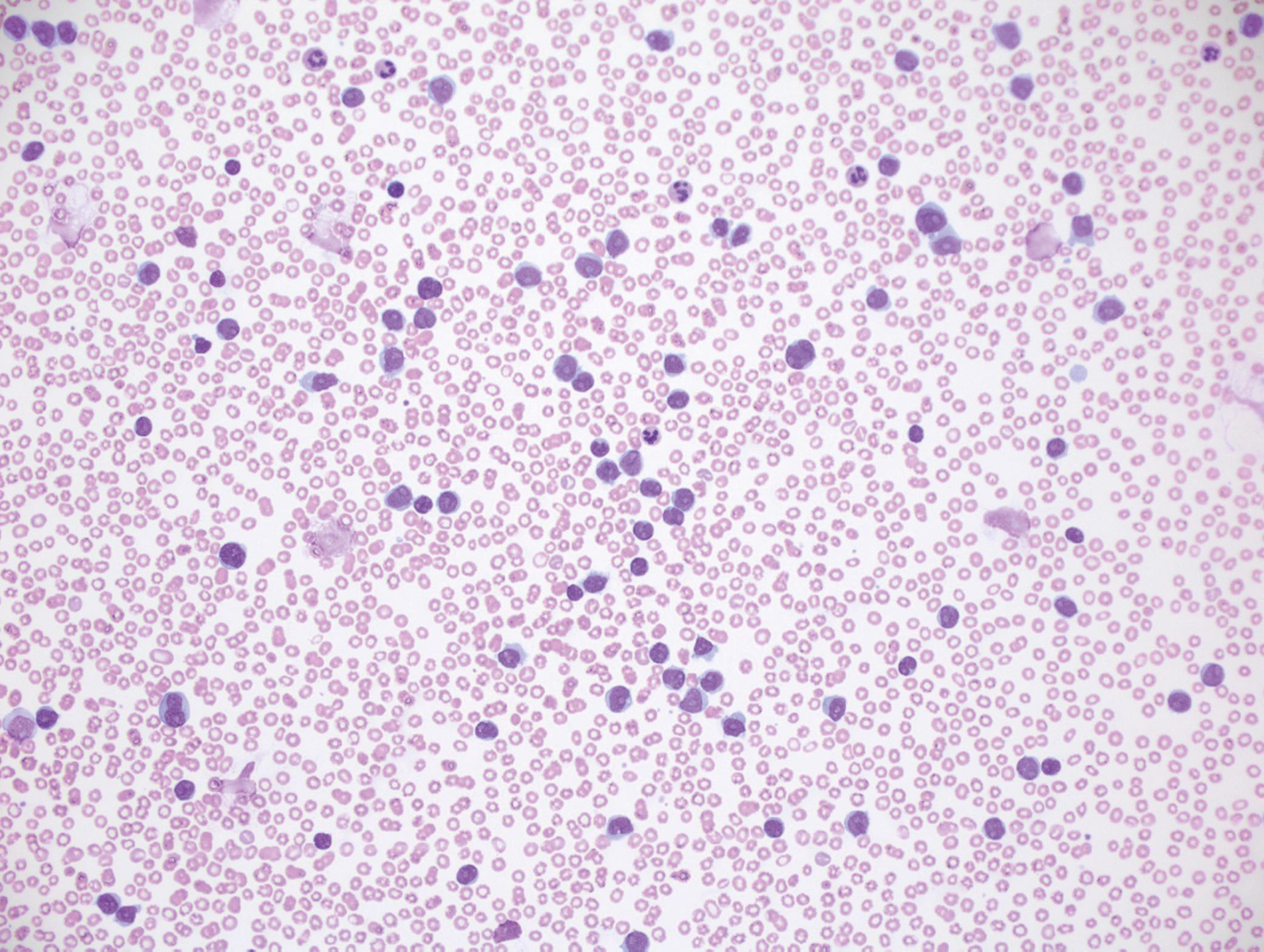 Fig. 10.17, B-cell prolymphocytic leukemia in peripheral blood (white blood cell count = 63.5 × 10 9 /L).