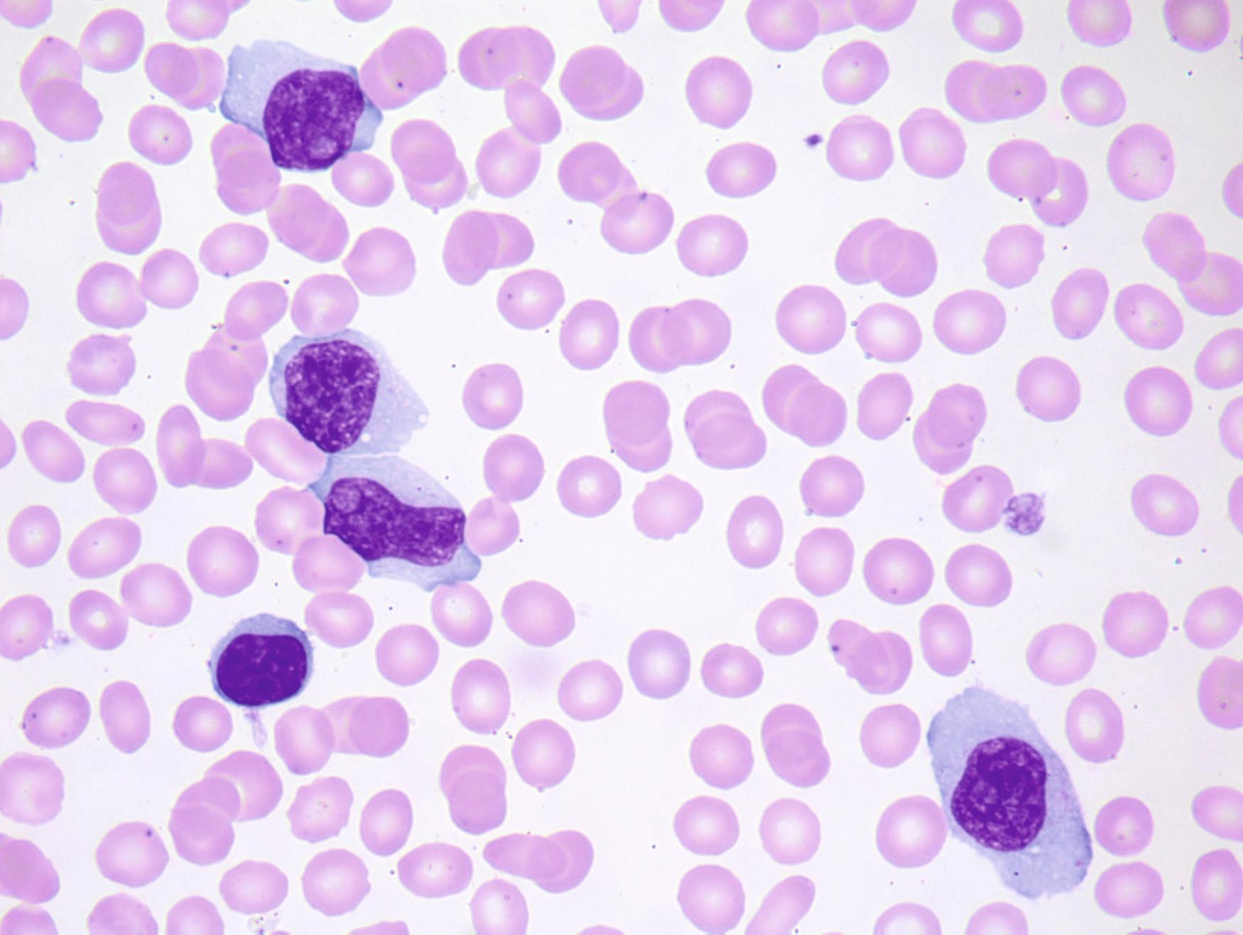 Fig. 10.20, B-cell prolymphocytic leukemia in peripheral blood. Some of the prolymphocytes have abundant cytoplasm, an unusual finding that may suggest reactive lymphocytes. However, the population is monotonous and shows nuclear irregularity, prominent nucleoli, and marked lymphocytosis, which are more consistent with a neoplastic population. One small, normal lymphocyte is present in the lower left.